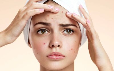 Come curare l’acne